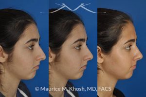 Photo of a patient before and after a procedure. Rhinoplasty for tip elevation, lowering of nasal hump, and narrowing the nasal tip