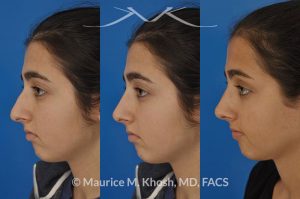 Photo of a patient before and after a procedure. Rhinoplasty for tip elevation, lowering of nasal hump, and narrowing the nasal tip