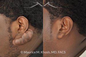 Photo of a patient before and after a procedure. Treatment for a very large keloid on the ear - One year post op result.