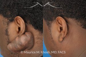 Photo of a patient before and after a procedure. Treatment for a very large keloid on the ear - One year post op result.