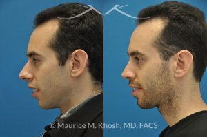 Photo of a patient before and after a procedure. Male nose job - This gentleman was interested in rhinoplasty to address a large hump, wide tip, excess nostril show, and wide nostrils. Surgery was performed via the open rhinoplasty approach.