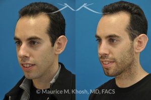 Photo of a patient before and after a procedure. Male nose job - This gentleman was interested in rhinoplasty to address a large hump, wide tip, excess nostril show, and wide nostrils. Surgery was performed via the open rhinoplasty approach.