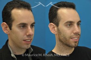 Photo of a patient before and after a procedure. Male nose job - This gentleman was interested in rhinoplasty to address a large hump, wide tip, excess nostril show, and wide nostrils. Surgery was performed via the open rhinoplasty approach.