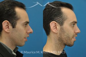 Photo of a patient before and after a procedure. Male nose job - This gentleman was interested in rhinoplasty to address a large hump, wide tip, excess nostril show, and wide nostrils. Surgery was performed via the open rhinoplasty approach.