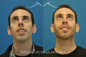 Photo of a patient before and after a procedure. Male nose job - This gentleman was interested in rhinoplasty to address a large hump, wide tip, excess nostril show, and wide nostrils. Surgery was performed via the open rhinoplasty approach.