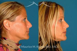 Photo of a patient before and after a procedure. Rhinoplasty for tip & dorsum - This patient was interested in addressing the hump on her nose and reducing the columellar show (hanging columella). Surgery was performed via the closed rhinoplasty approach.