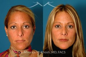 Photo of a patient before and after a procedure. Rhinoplasty for tip & dorsum - This patient was interested in addressing the hump on her nose and reducing the columellar show (hanging columella). Surgery was performed via the closed rhinoplasty approach.