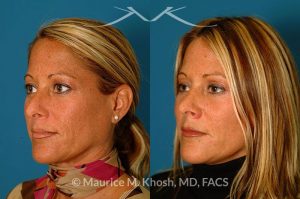 Photo of a patient before and after a procedure. Rhinoplasty for tip & dorsum - This patient was interested in addressing the hump on her nose and reducing the columellar show (hanging columella). Surgery was performed via the closed rhinoplasty approach.