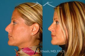 Photo of a patient before and after a procedure. Rhinoplasty for tip & dorsum - This patient was interested in addressing the hump on her nose and reducing the columellar show (hanging columella). Surgery was performed via the closed rhinoplasty approach.