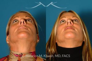 Photo of a patient before and after a procedure. Rhinoplasty for tip & dorsum - This patient was interested in addressing the hump on her nose and reducing the columellar show (hanging columella). Surgery was performed via the closed rhinoplasty approach.