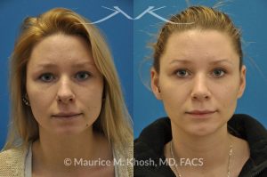 Photo of a patient before and after a procedure. Rhinoplasty and chin implant