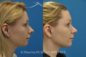 Photo of a patient before and after a procedure. Rhinoplasty and chin implant