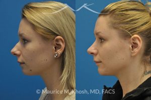 Photo of a patient before and after a procedure. Rhinoplasty and chin implant