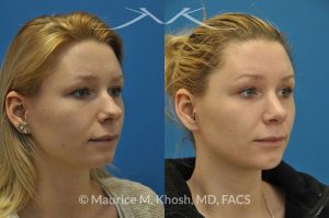 Photo of a patient before and after a procedure. Rhinoplasty and chin implant