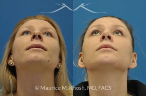 Photo of a patient before and after a procedure. Rhinoplasty and chin implant