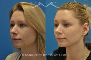 Photo of a patient before and after a procedure. Rhinoplasty and chin implant