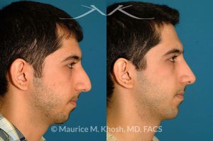 Photo of a patient before and after a procedure. Rhinoplasty and chin implant