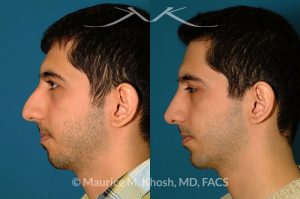 Photo of a patient before and after a procedure. Rhinoplasty and chin implant