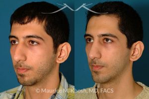 Photo of a patient before and after a procedure. Rhinoplasty and chin implant