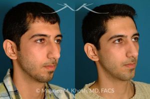 Photo of a patient before and after a procedure. Rhinoplasty and chin implant