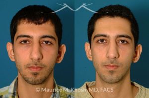 Photo of a patient before and after a procedure. Rhinoplasty and chin implant