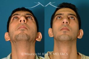 Photo of a patient before and after a procedure. Rhinoplasty and chin implant