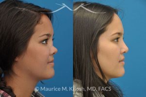 Photo of a patient before and after a procedure. Saddle Nose