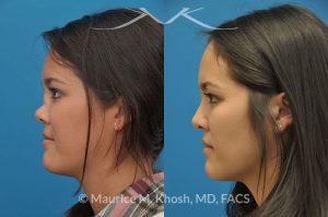 Photo of a patient before and after a procedure. Saddle Nose