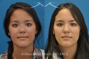 Photo of a patient before and after a procedure. Saddle Nose