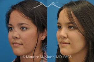 Photo of a patient before and after a procedure. Saddle Nose