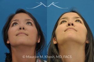 Photo of a patient before and after a procedure. Saddle Nose