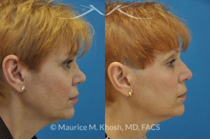 Photo of a patient before and after a procedure. Saddle Nose