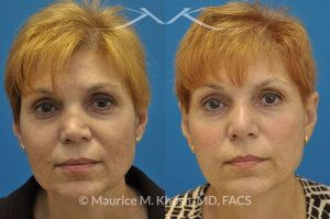 Photo of a patient before and after a procedure. Saddle Nose