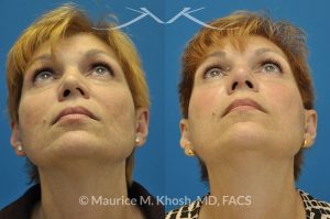 Photo of a patient before and after a procedure. Saddle Nose