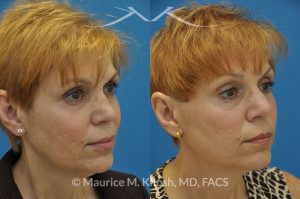 Photo of a patient before and after a procedure. Saddle Nose