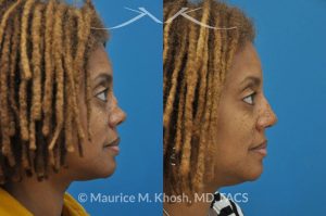 Photo of a patient before and after a procedure. Saddle Nose