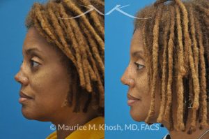 Photo of a patient before and after a procedure. Saddle Nose