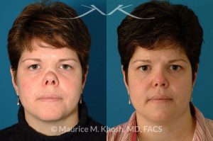 Photo of a patient before and after a procedure. Saddle Nose