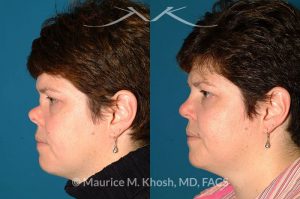 Photo of a patient before and after a procedure. Saddle Nose