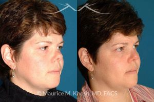 Photo of a patient before and after a procedure. Saddle Nose