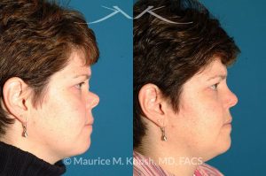 Photo of a patient before and after a procedure. Saddle Nose