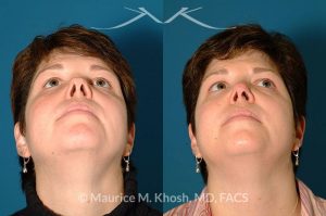 Photo of a patient before and after a procedure. Saddle Nose