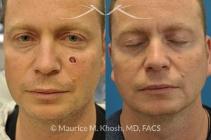 Photo of a patient before and after a procedure. Cheek reconstruction after Mohs skin cancer removal