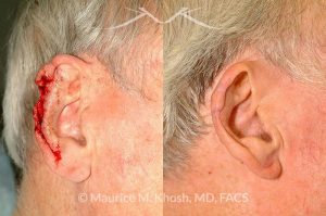 Photo of a patient before and after a procedure. Ear reconstruction after Mohs skin cancer removal