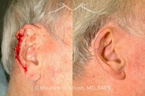 Photo of a patient before and after a procedure. Ear reconstruction after Mohs skin cancer removal - before and after photos.
