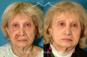 Photo of a patient before and after a procedure. Lip reconstruction for Mohs skin cancer defect