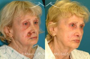 Photo of a patient before and after a procedure. Lip reconstruction for Mohs skin cancer defect - before and after photos.