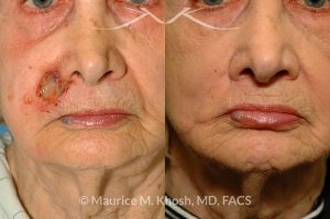 Photo of a patient before and after a procedure. Lip reconstruction for Mohs skin cancer defect