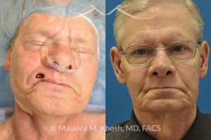 Photo of a patient before and after a procedure. Lip reconstruction