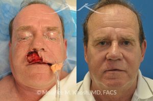 Photo of a patient before and after a procedure. Lip reconstruction for Mohs skin cancer defect
